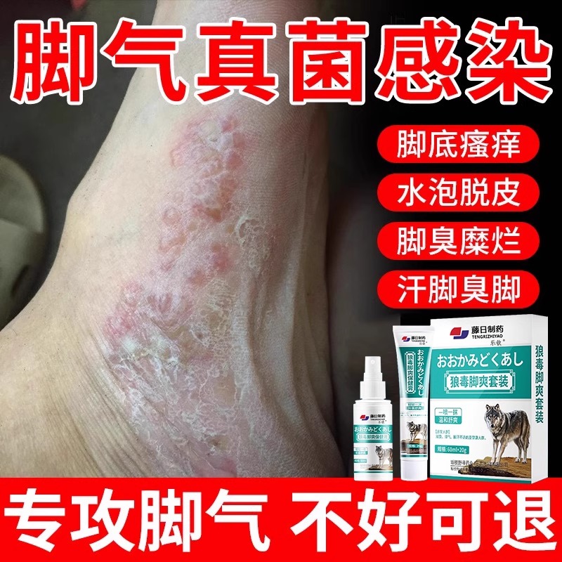 狼毒脚气喷剂喷雾臭烂脚丫脱皮糜烂脚趾缝烂痒脱皮杀菌止痒膏wp