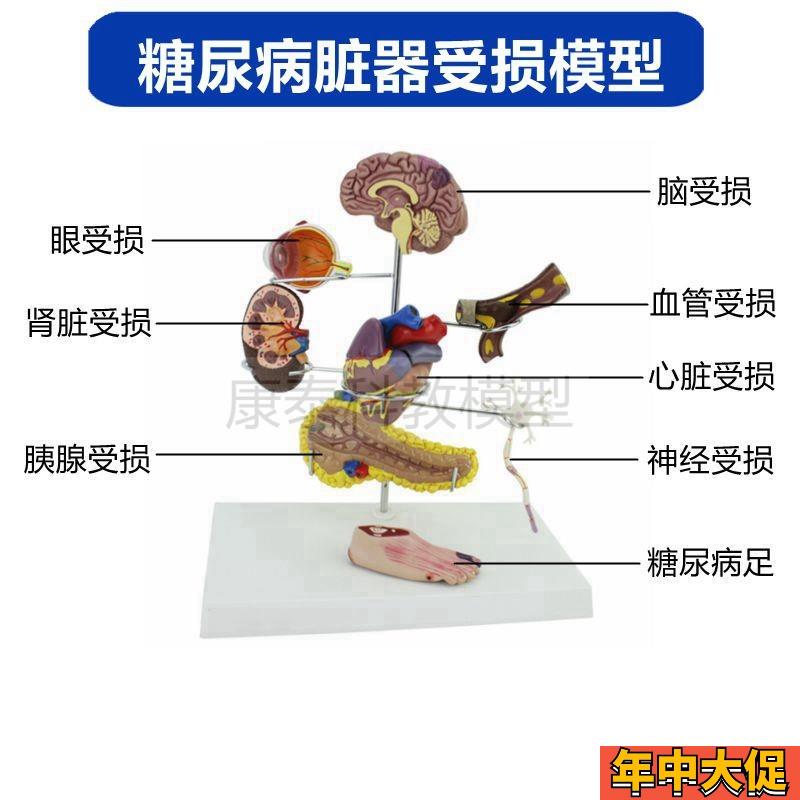 糖尿模型脏器受损病理内分泌医患沟通眼底脑足心脏血管变化可拆卸