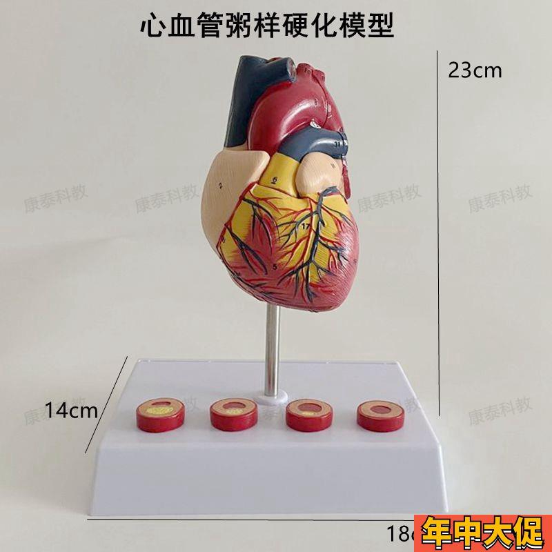 康泰模型心血管粥样硬化狭窄阻塞病理冠状动脉临床医药促销人体心