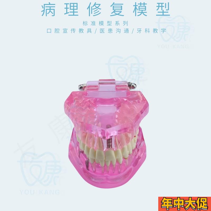 牙齿模型病理修复可拆卸正畸口腔病理牙模型牙科医患活动沟通