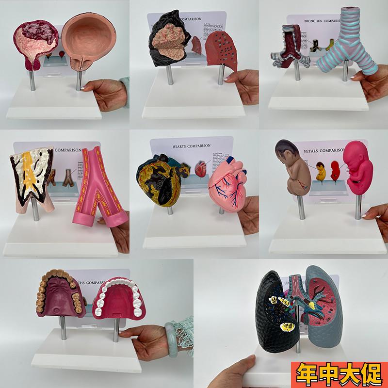 人体正常内脏吸烟病变器官对比心肺部膀胱血管口腔气管胎医用模型