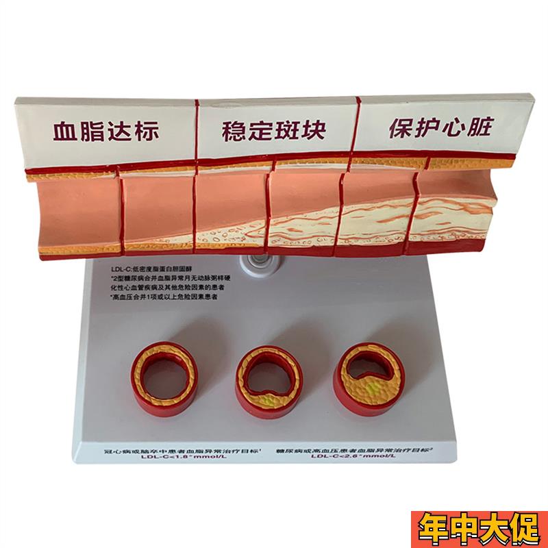 血管活动堵塞动支脉粥样硬化心血管动脉硬化模型血管病理模型血栓