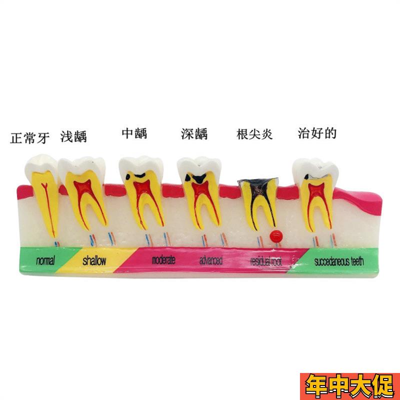 牙科口腔教学 龋齿分类模型 牙齿龋坏病变变 演示讲解 医患沟通M7