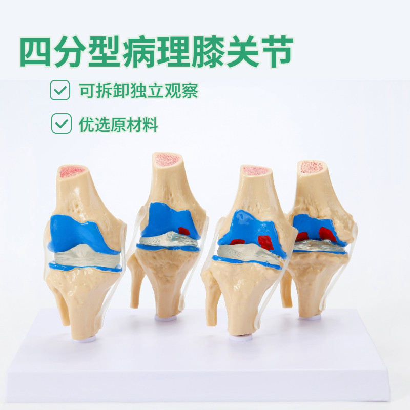 人体病理膝关节模型病变四分型膝C关节退行性膝关节关节镜手术沟
