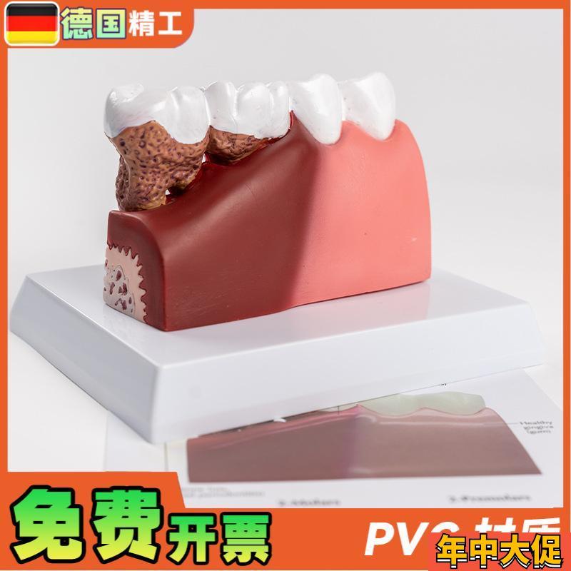 德国】病理牙模型成人病理牙齿模型 口腔模型牙科教学模型 演示模