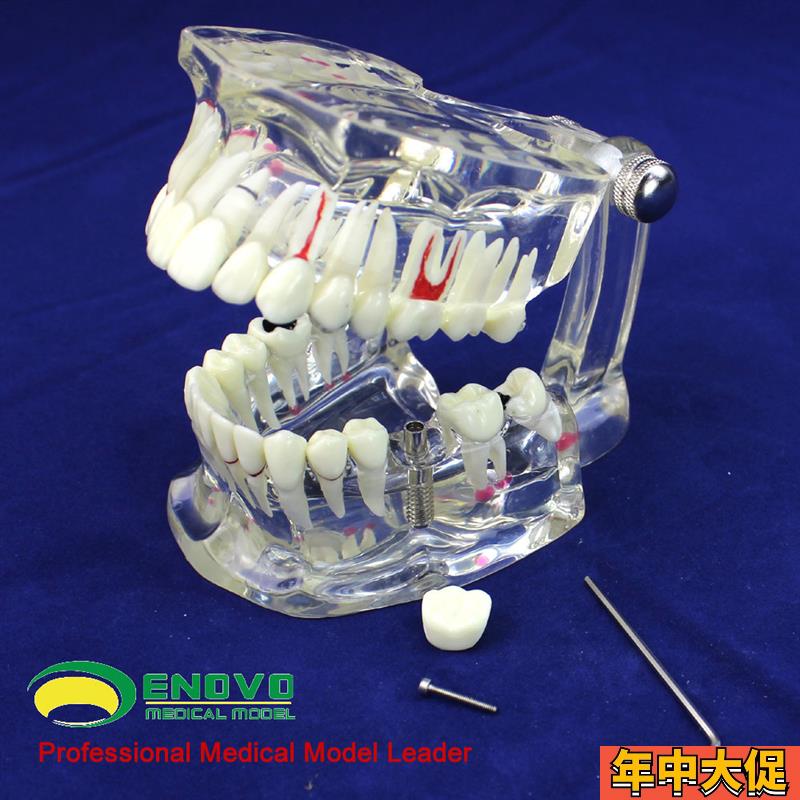 ENOVO颐诺牙齿模型口腔牙齿科种植模型口腔病理模型种植体牙冠义