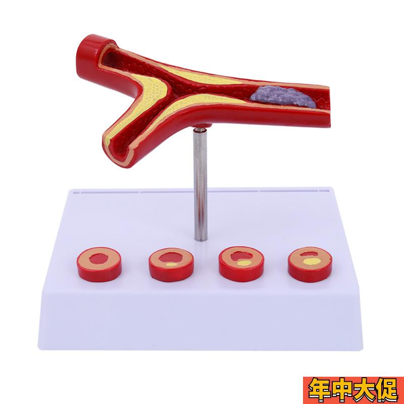 动脉性心血管冠状模型 硬化动脉模型 老年心脏模型 形成血栓模型