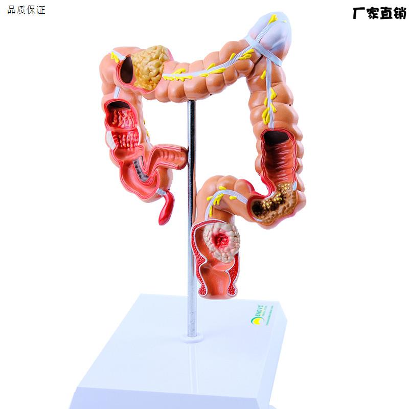 ENOVO颐诺人体大肠疾病展示模型结肠直肠o道病变症状消化系统疾病