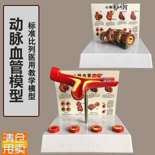人体支脉b粥样形成模型血管模型血液科动脉模型教学血管模型