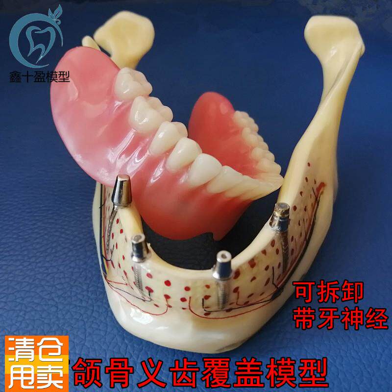 牙科口腔下颌骨展示模型透明下颌骨展G示种植钉义齿修复模型6005