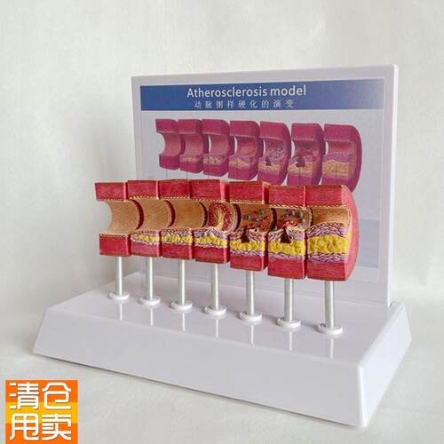 人体血管模型内膜病m理阻塞狭窄脂肪堆积中老年人心脏冠状动脉栓