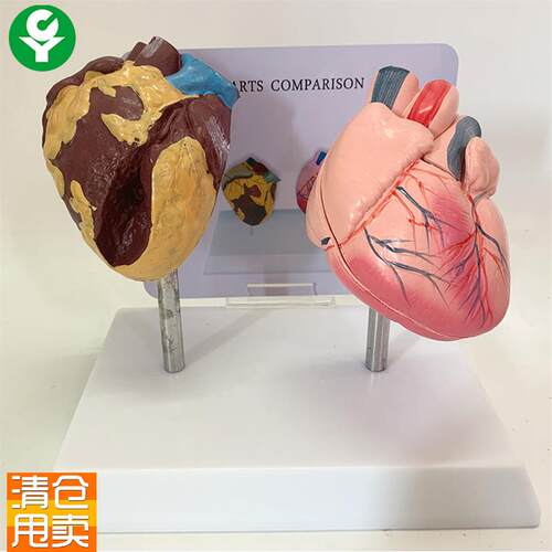 健康人与吸烟人的心脏比较演示模型H心脏模型病理心脏解剖模型
