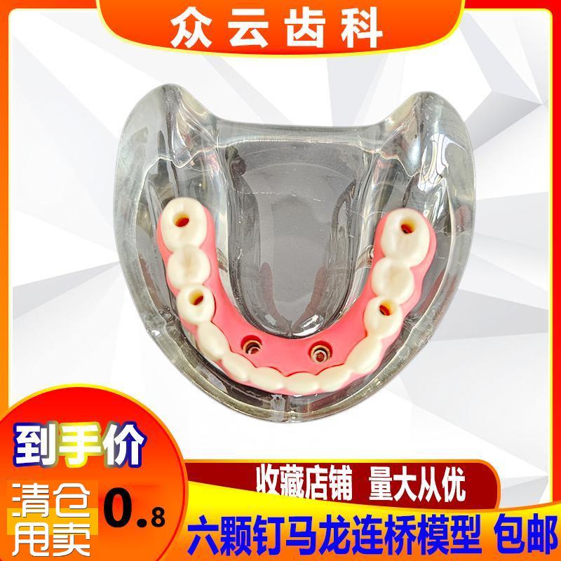 牙科种植体c修复模型种植钉球帽结合半口综合病理种植与无牙颌模