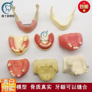 口腔种植练习模型打孔栽钉种植实操上颌窦提升下W颌骨种植练习