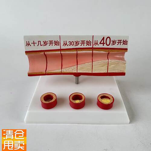 心脑血管堵塞模型k关节血栓血液浓度脂肪病理粥样硬化人体解剖教