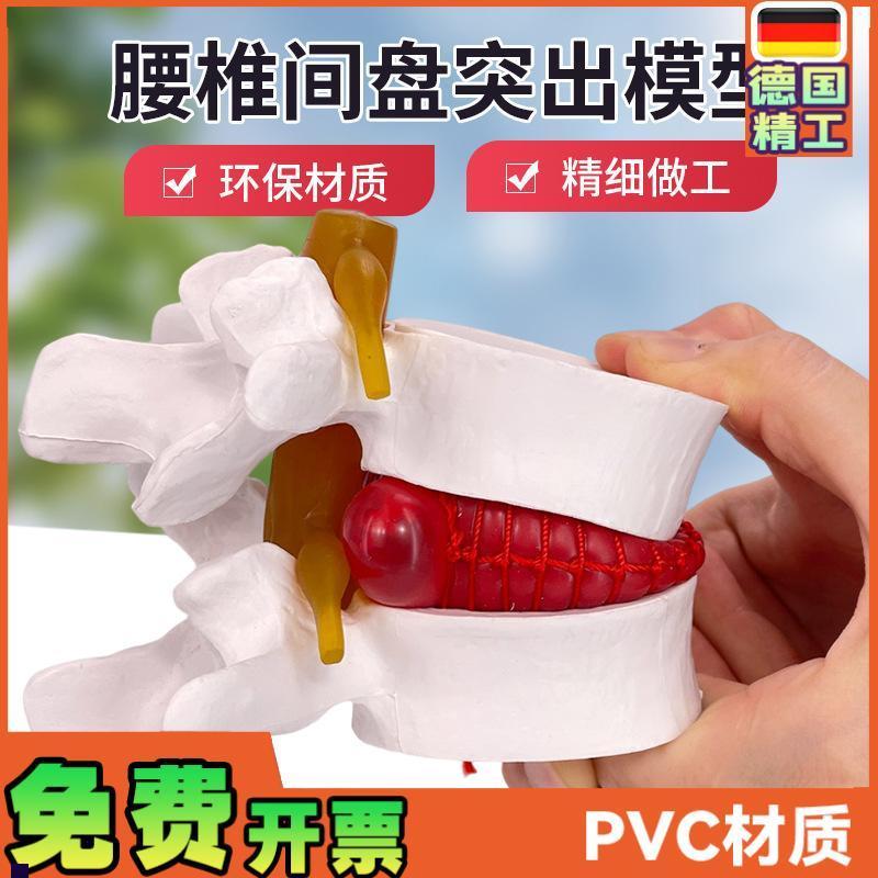 腰椎放大腰椎间盘受压演示模型人体脊柱脊椎骨病理演示.关节医学