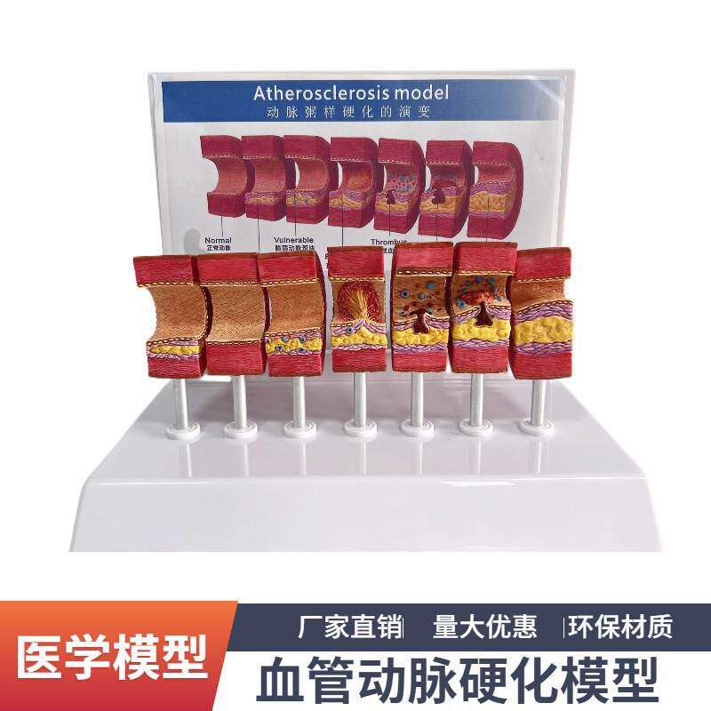 7节动脉粥样硬化模型血管血栓栓塞演示模M型人体血管模型医用教具
