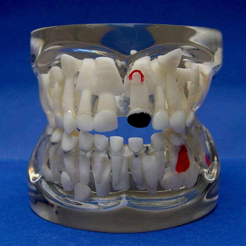 ENOVO颐诺儿童乳牙早期病态牙列模型 牙齿发育幼儿牙X齿护理教学