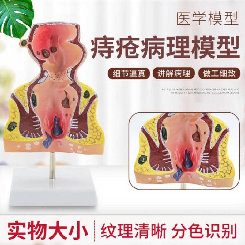 大号人体直肠模型结肠病理直肠痔疮直肠常见病模c型直肠和肛管模