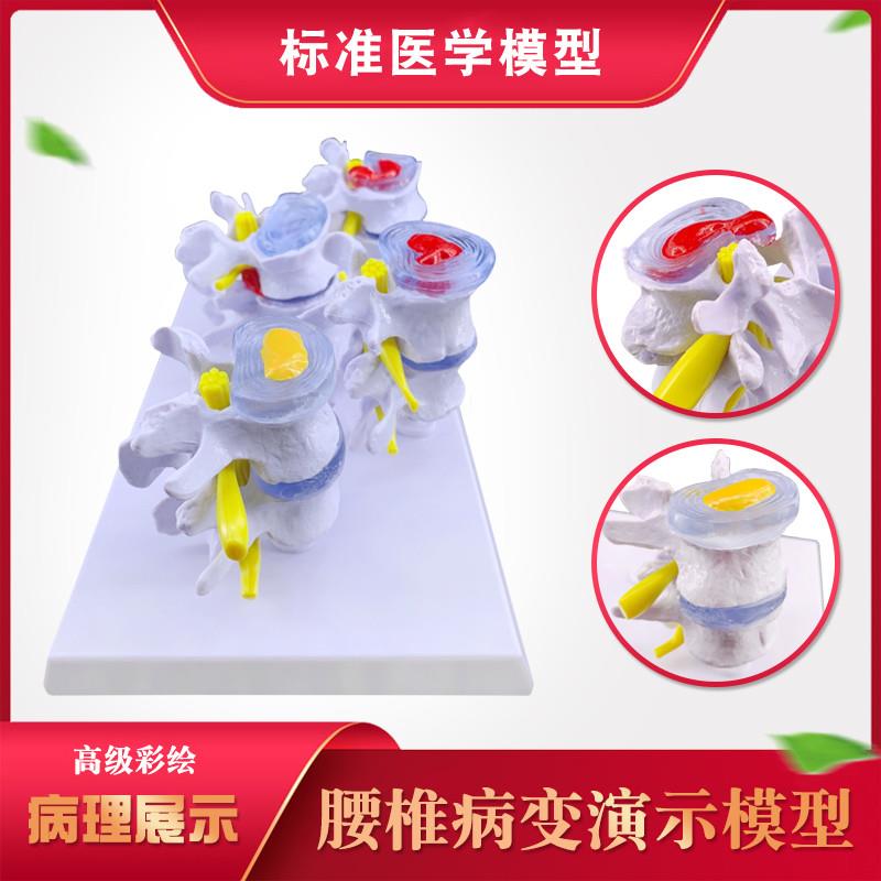 四分型脊椎正f常与病变腰椎组合模型 椎间盘病理腰椎演示过程 病