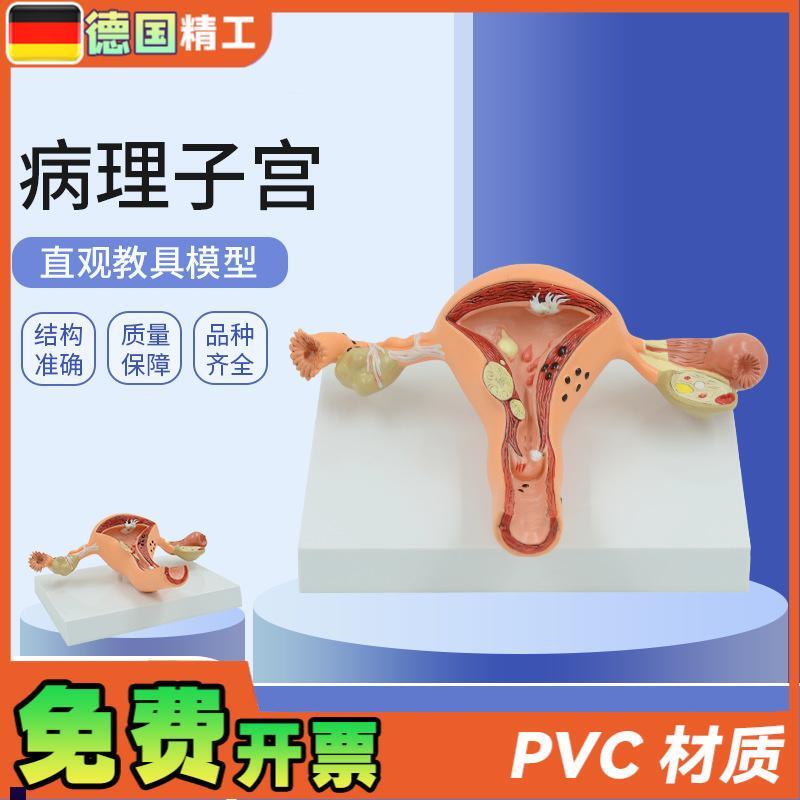 德国人体模型女性生殖子宫阴道卵巢子宫教学模P具病理变化科普培