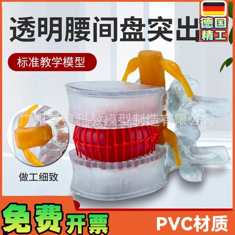 腰椎放大腰d椎间盘模型挤压突出演示脊柱脊椎骨病理演示模型