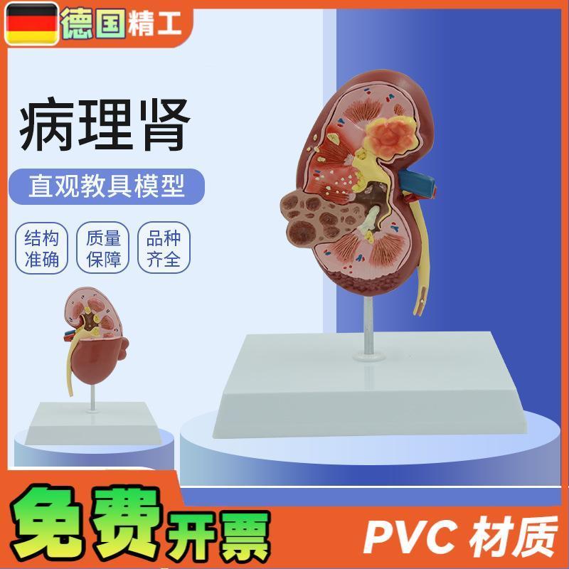 德国人体肾脏结构病变内脏器官解剖模型泌尿O科肾小球肾单位教学