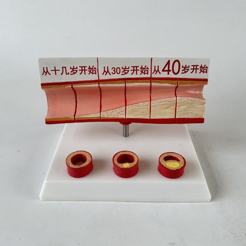 心脑血管堵塞模型关节血栓血液浓C度脂肪病理粥样硬化人体解剖教