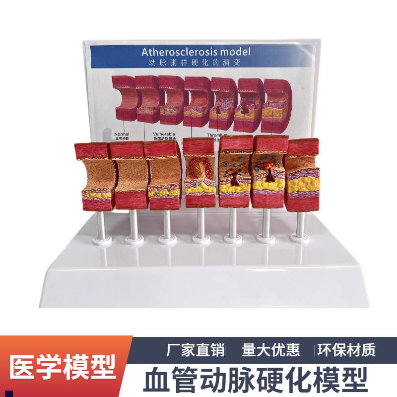 7节动脉粥样硬化模型血管血栓栓塞演示模型人P体血管模型医用教具