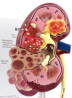 颐诺正品医用人体肾脏病解剖模型肾脏内科肾结石泌Y尿内外科模型