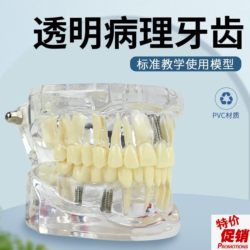 牙科修复模型口腔科病理医v患沟通教学修复体综合带神经可拆卸牙