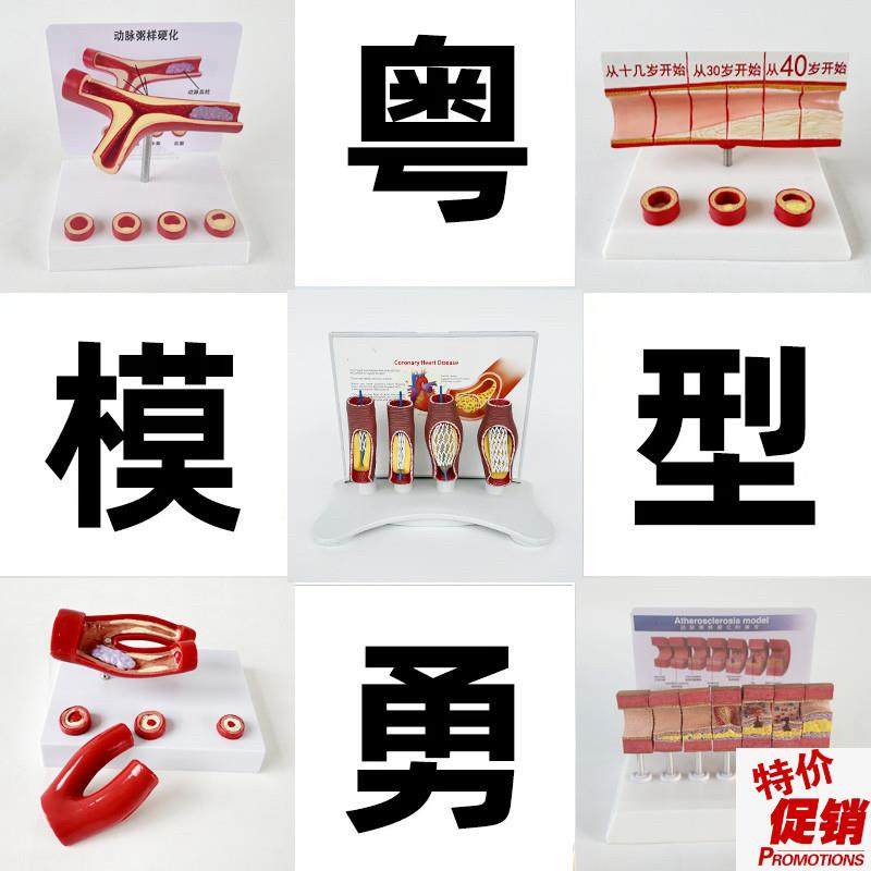 动态血管c粘稠堵塞模型动支脉粥样硬化心血管支架放大病理教学模,文具电教/文化用品/商务用品,教学标本/模型,淘宝优惠券,粉丝福利购,淘宝优惠卷
