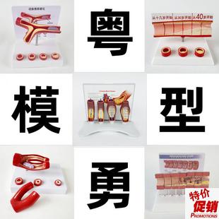动态血管c粘稠堵塞模型动支脉粥样硬化心血管支架放大病理教学模