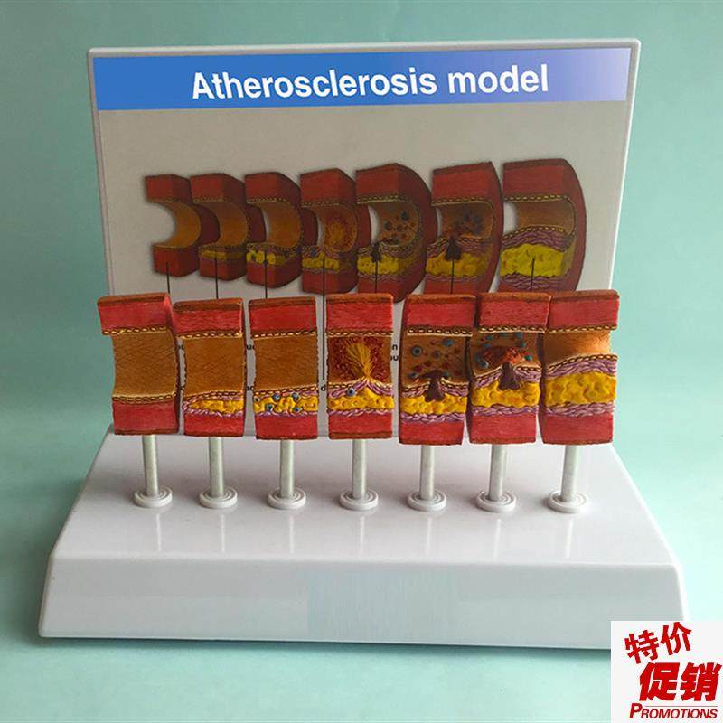 动脉粥样硬化模型血管p血栓栓塞模型动脉血管人体医用医学教学教