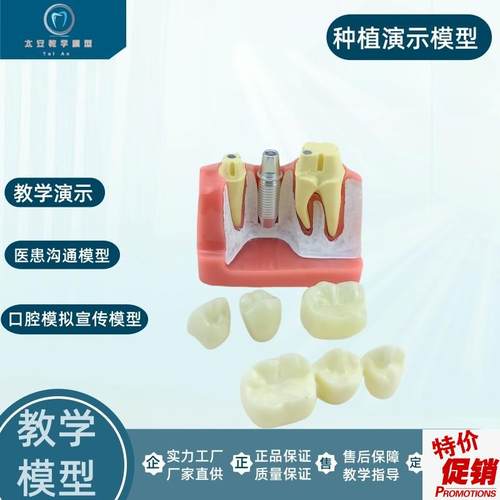 牙科口腔种植模型演示模型医患沟K通教学练习种植牙模型