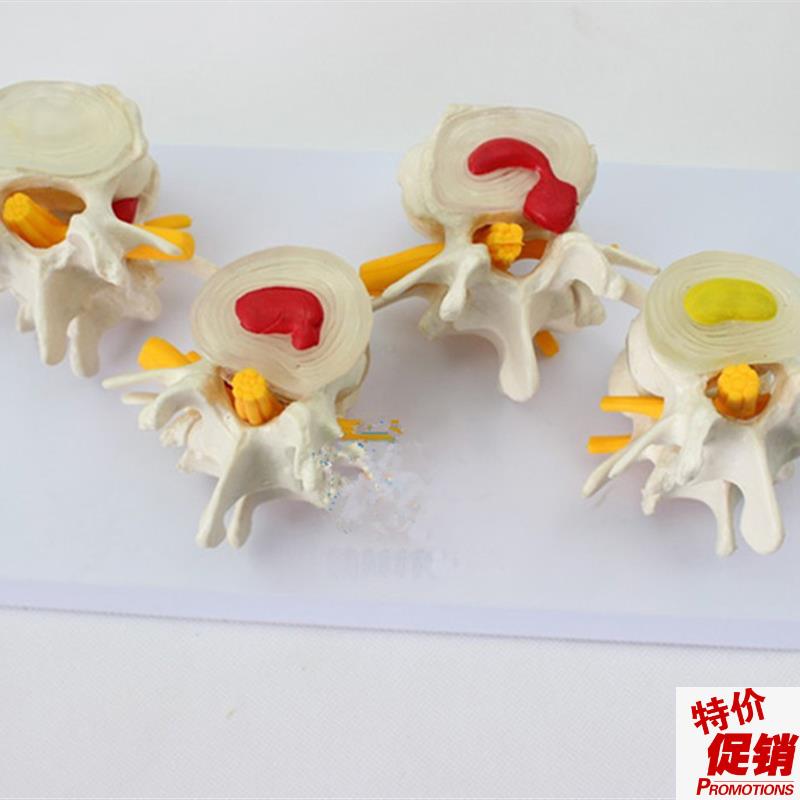 4阶段病态腰椎比较模型人体四个时期病变腰部脊U柱脊椎模具标本