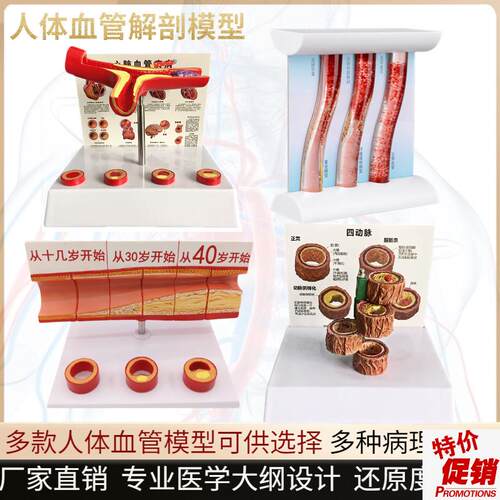 血管堵塞动支脉粥样硬化心血x管动脉硬化模型血管病理动态血栓模