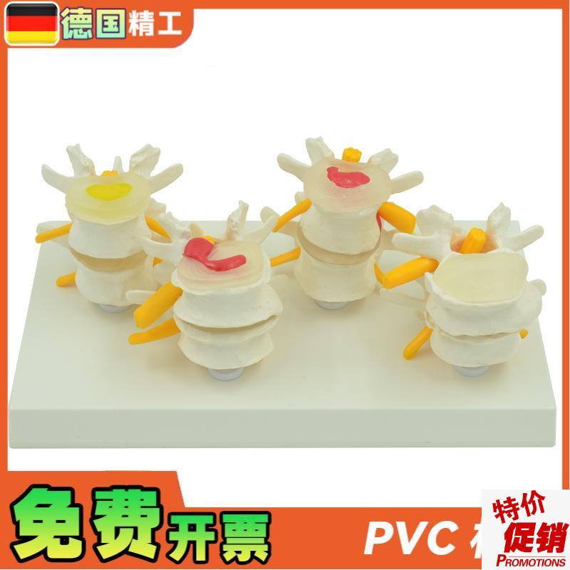 德国】4阶d段病变腰椎模型人体骨骼解剖椎体医学教学器材