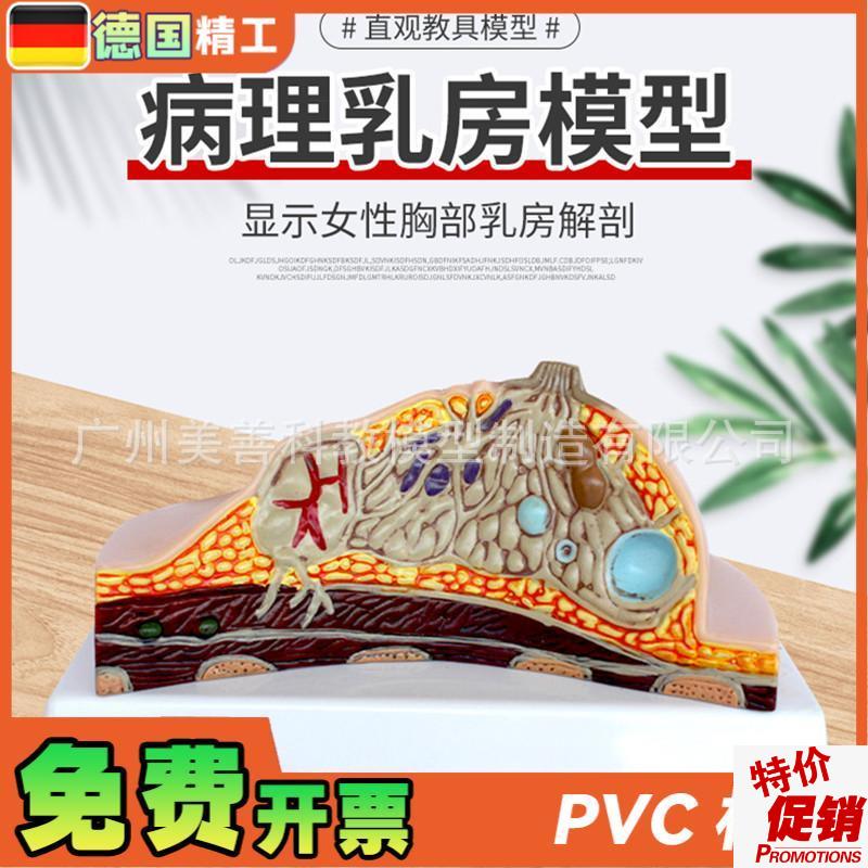 病理乳房模型乳房病变模t型乳房解剖模型乳房常见疾病乳房模型
