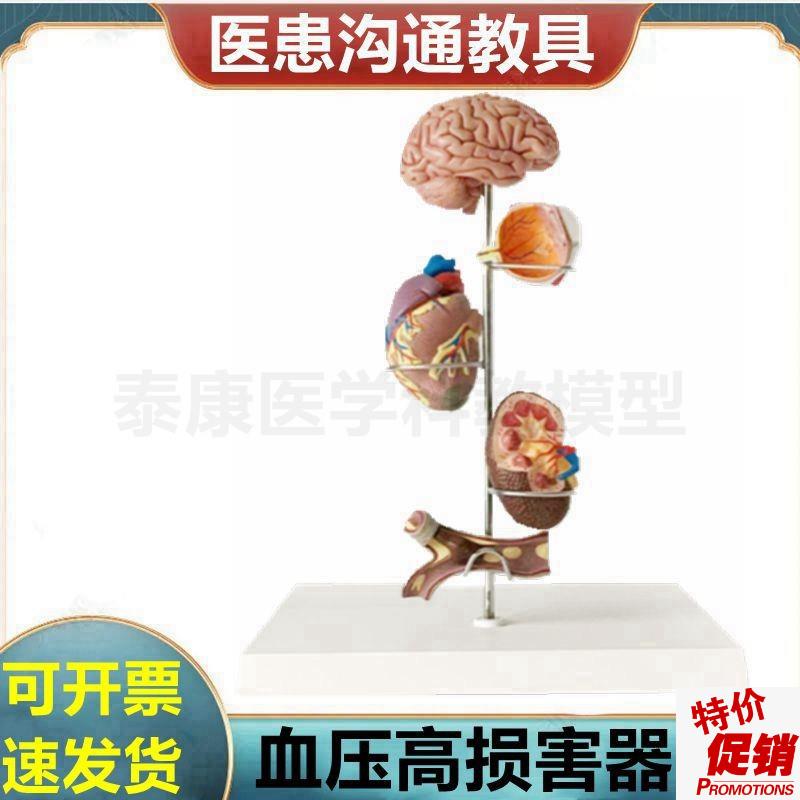 心脑血管模型血液l压力升高病理脏器受损糖尿眼底肾脏冠状动脉阻