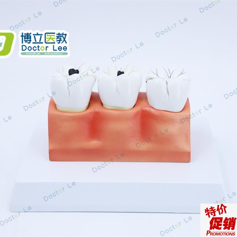 教学仿真龋齿模型牙齿模型病变牙齿模型3颗龋Q齿模型龋齿分解模型