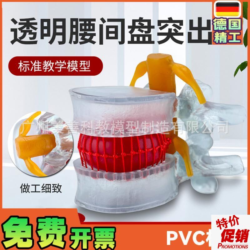 腰椎放大b腰椎间盘模型挤压突出演示脊柱脊椎骨病理演示模型