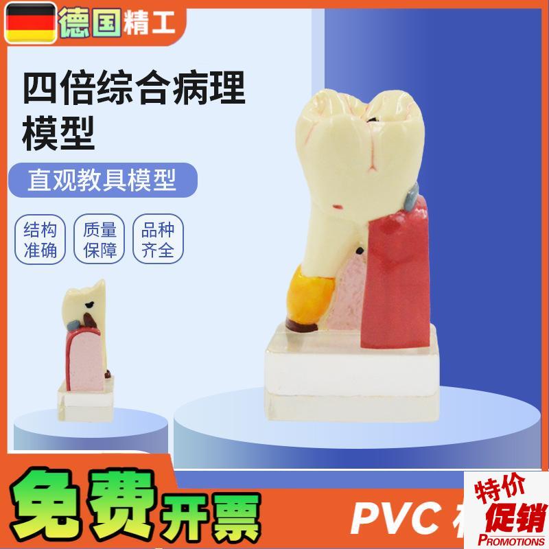 德国PNT-OR11四倍综合病理蛀牙模型牙J齿病变综合病理模型牙齿解