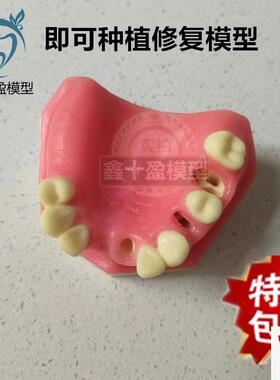 口腔种植a练习模型上颌骨上颌窦牙列缺失种植体齿科牙齿模型PIM-2