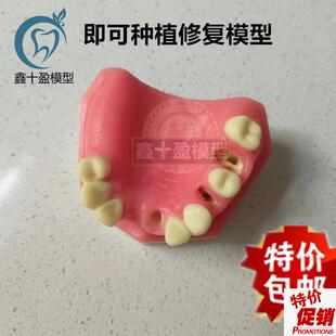 口腔种植a练习模型上颌骨上颌窦牙列缺失种植体齿科牙齿模型PIM-2