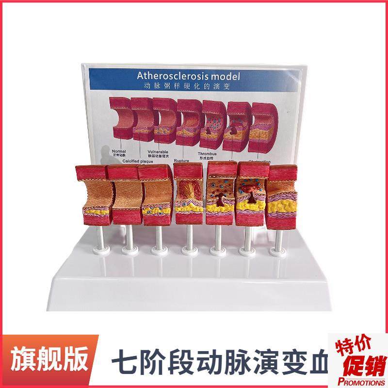 动脉粥样硬化模型血管血栓栓塞模B型动脉血管人体医用医学教学教