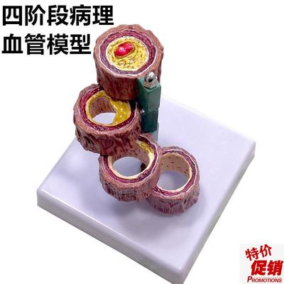 血管模型血栓人体支脉/粥样/硬B化心血管动脉模型心内科教学通用