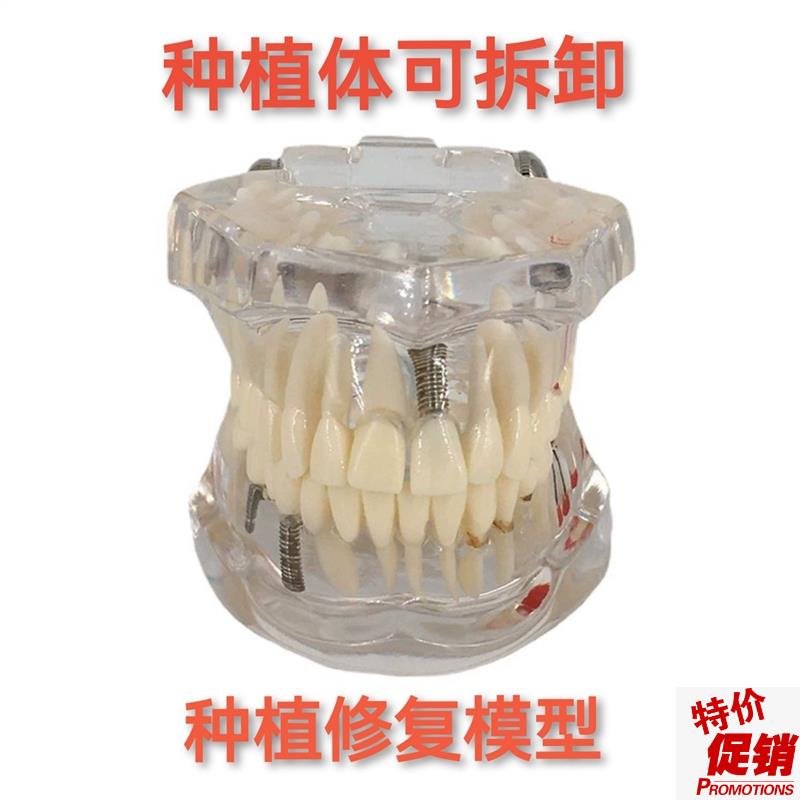 牙科材料修e复牙模型水晶病理牙模型活动种植牙模型包邮