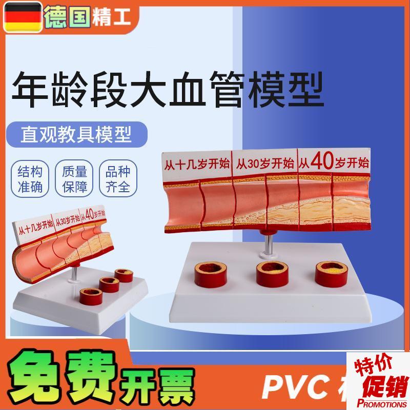 德国】年龄e段大血管模型4部件/硬化心血管动脉/硬化模型血管病