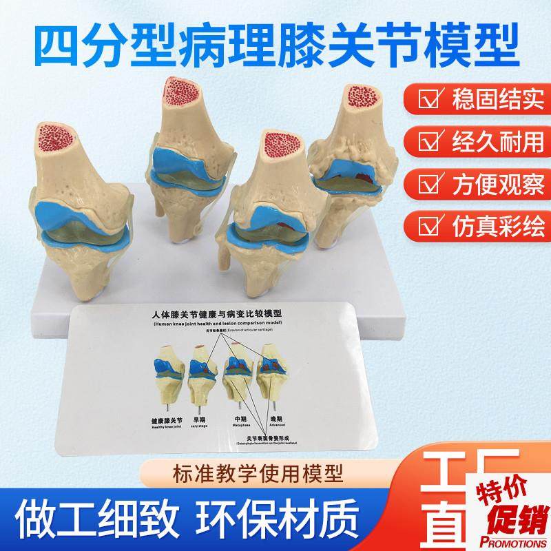 人体四阶段e病理膝关节骨骼结构解剖模型病态膝盖骨质教学骨科展,玩具/童车/益智/积木/模型,其他模型玩具,淘宝优惠券,粉丝福利购,淘宝优惠卷